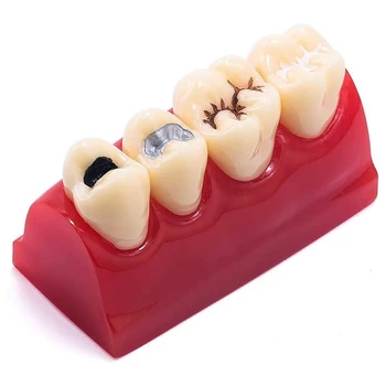 Model zębów Patologii, Model Pokazowy Uszczelniacz, Model Zęba Na Szkolenia, pokazy, szkolenia